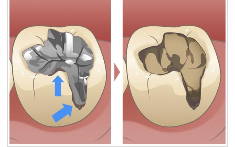 二次カリエスとは？