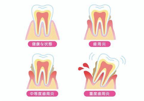 歯周病について